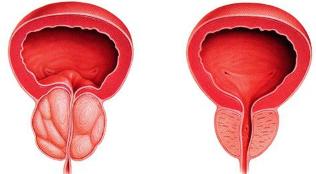 the difference between the sick and the healthy prostate