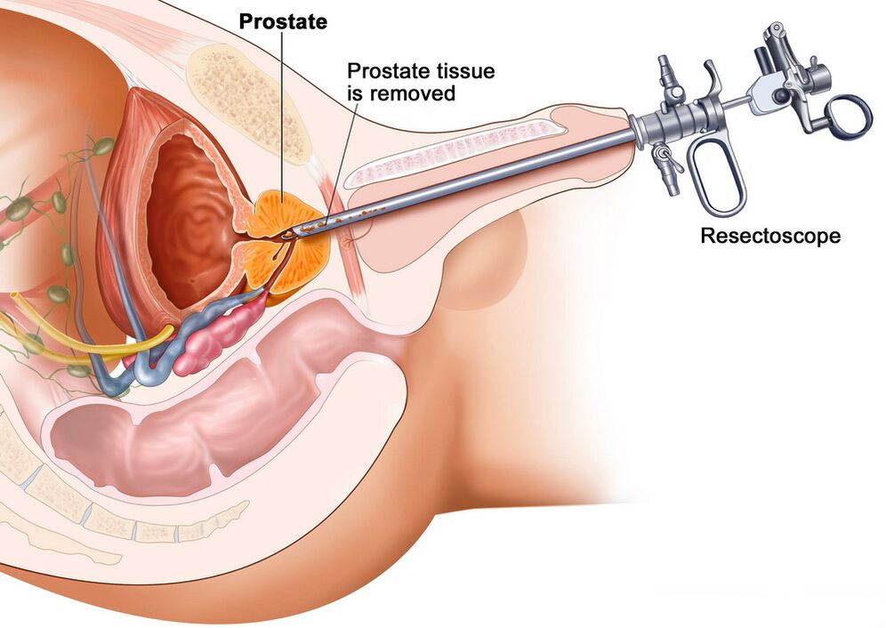 Removal of prostate tissue for accurate diagnosis of prostatitis